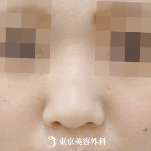 【鼻中隔延長（耳介軟骨）・オーダープロテーゼ｜ok6561】の症例写真 before【5枚目】