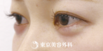 【涙袋ヒアルロン酸｜si1345】メイク感覚でナチュラルなやさしい目元にの症例