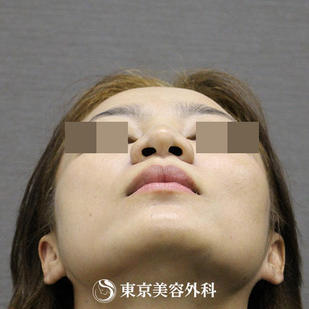 【鼻尖形成&鼻プロテーゼ&鼻孔縁形成｜si172】の症例写真 before【7枚目】
