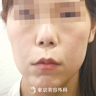 【スレッドリフト（N-COG）｜um1404】の症例写真 after【6枚目】