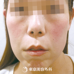 【スレッドリフト（N-COG）｜um1404】の症例写真 before【5枚目】