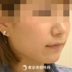 【小顔エラ骨切り（口外法）｜si2331】口外法のエラ骨切りでスッキリとした小顔にの症例