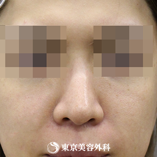 【鼻尖形成｜si354】の症例写真 before【1枚目】
