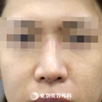 【鼻尖形成｜si354】鼻先をシャープにしてすっきりとした鼻にの症例