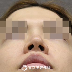 【鼻尖形成｜si354】の症例写真 before【9枚目】
