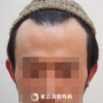 【オリジナル発毛薬・メソセラピー｜fy2921】男性発毛 年齢：28歳の症例