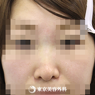 【鼻ヒアルロン酸｜si1499】の症例写真 after【2枚目】