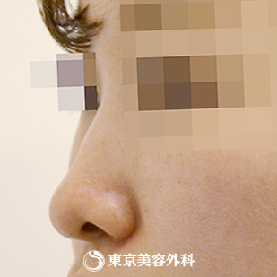 【鼻ヒアルロン酸｜si1499】の症例写真 before【3枚目】