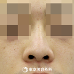 【鼻プロテーゼ（オーダーメイド）｜si872】スッと綺麗な鼻筋にの症例