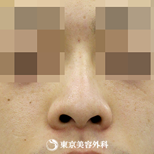 【鼻プロテーゼ（オーダーメイド）｜si872】の症例写真 before【1枚目】
