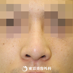 【鼻プロテーゼ（オーダーメイド）｜si872】の症例写真 after【2枚目】