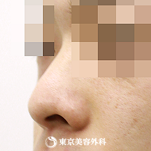 【鼻プロテーゼ（オーダーメイド）｜si872】の症例写真 before【3枚目】