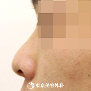【鼻プロテーゼ（オーダーメイド）｜si872】の症例写真 before【5枚目】