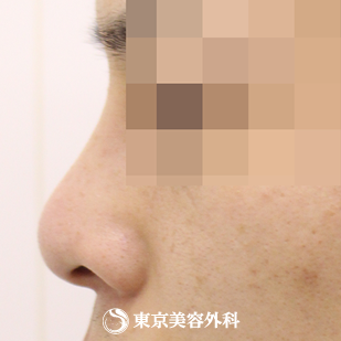 【鼻プロテーゼ（オーダーメイド）｜si872】の症例写真 after【6枚目】