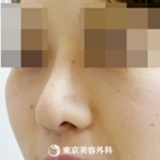 【鼻尖形成&鼻中隔延長&鼻プロテーゼ&ハンプ削り｜gz3012】丸い鼻をすっきりと細い鼻先にの症例