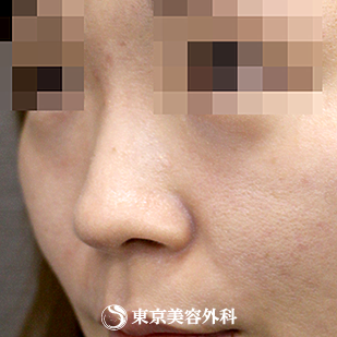 【鼻尖形成（軟骨移植）、隆鼻術（プロテーゼ）｜si1218】の症例写真 before【1枚目】