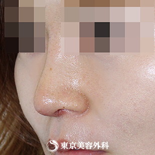【鼻尖形成（軟骨移植）、隆鼻術（プロテーゼ）｜si1218】の症例写真 術後1ヵ月【2枚目】