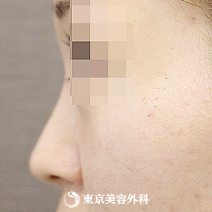 【鼻尖形成（軟骨移植）、隆鼻術（プロテーゼ）｜si1218】の症例写真 before【3枚目】