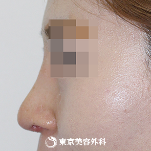 【鼻尖形成（軟骨移植）、隆鼻術（プロテーゼ）｜si1218】の症例写真 術後1ヵ月【4枚目】