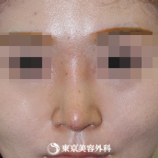 【鼻尖形成（軟骨移植）、隆鼻術（プロテーゼ）｜si1218】の症例写真 術後1ヵ月【6枚目】