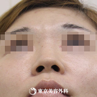 【鼻尖形成（軟骨移植）、隆鼻術（プロテーゼ）｜si1218】の症例写真 before【7枚目】