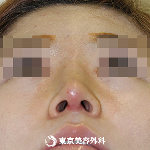 【鼻尖形成（軟骨移植）、隆鼻術（プロテーゼ）｜si1218】の症例写真 術後1ヵ月【8枚目】