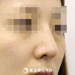 【鼻尖形成&鷲鼻削り｜si302】鼻尖形成で鼻先を整えてシャープな鼻にの症例