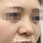 【鼻尖形成（軟骨移植）・隆鼻術（シリコンプロテーゼ）｜si4002】スッと鼻先の高い鼻にの症例