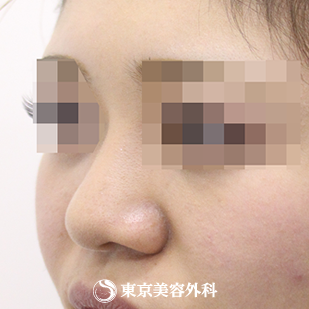 【鼻尖形成（軟骨移植）・隆鼻術（シリコンプロテーゼ）｜si4002】の症例写真 before【3枚目】