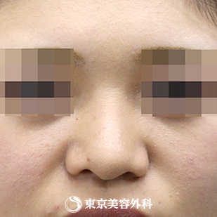 【鼻尖形成（軟骨移植）・隆鼻術（シリコンプロテーゼ）｜si4002】の症例写真 before【7枚目】