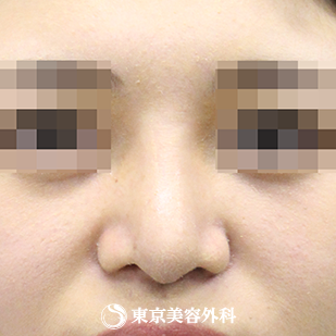 【鼻尖形成（軟骨移植）・隆鼻術（シリコンプロテーゼ）｜si4002】の症例写真 術後1ヵ月【8枚目】