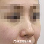斜鼻・鼻尖形成（軟骨移植）｜si558】綺麗なラインの鼻にの症例