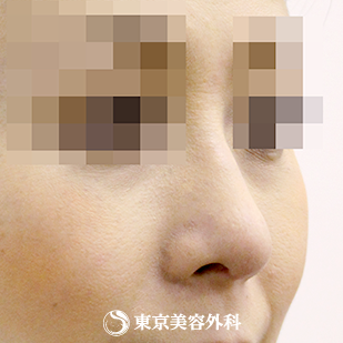 【斜鼻・鼻尖形成（軟骨移植）｜si558】の症例写真 after【2枚目】