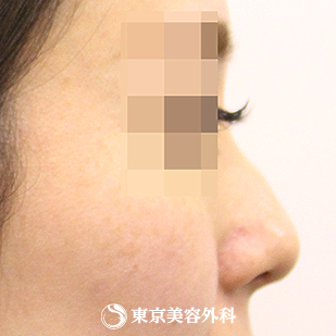 【斜鼻・鼻尖形成（軟骨移植）｜si558】の症例写真 before【3枚目】