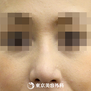 【斜鼻・鼻尖形成（軟骨移植）｜si558】の症例写真 after【6枚目】