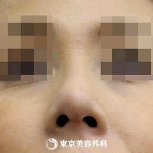【斜鼻・鼻尖形成（軟骨移植）｜si558】の症例写真 after【8枚目】