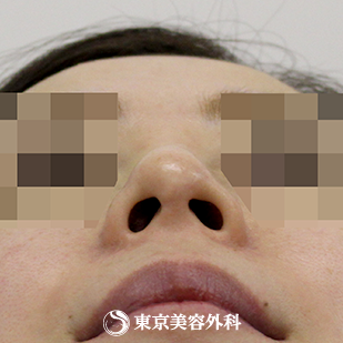 【斜鼻・鼻尖形成（軟骨移植）｜si558】の症例写真 before【9枚目】