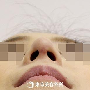 【斜鼻・鼻尖形成（軟骨移植）｜si558】の症例写真 after【10枚目】