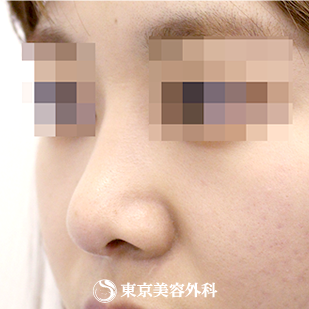 【鼻尖形成（軟骨移植）｜si840】の症例写真 術後1.5ヵ月【2枚目】