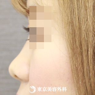 【鼻尖形成（軟骨移植）｜si840】の症例写真 before【3枚目】