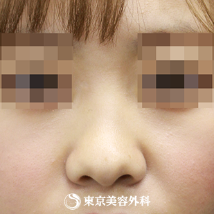 【鼻尖形成（軟骨移植）｜si840】の症例写真 before【5枚目】