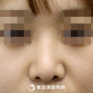【鼻尖形成（軟骨移植）｜si840】の症例写真 術後1.5ヵ月【6枚目】