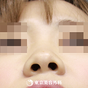 【鼻尖形成（軟骨移植）｜si840】の症例写真 before【7枚目】