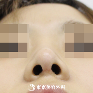 【鼻尖形成（軟骨移植）｜si840】の症例写真 術後1.5ヵ月【8枚目】