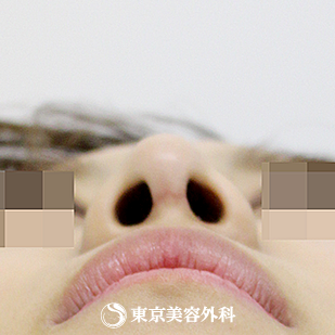【鼻尖形成（軟骨移植）｜si840】の症例写真 術後1.5ヵ月【10枚目】