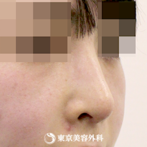 【鼻尖形成、鷲鼻削り(ハンプ削り)、鼻骨骨切り(幅寄せ)｜si941】鼻筋の通った綺麗な鼻にの症例