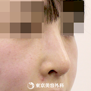 【鼻尖形成、鷲鼻削り(ハンプ削り)、鼻骨骨切り(幅寄せ)｜si941】の症例写真 after【2枚目】