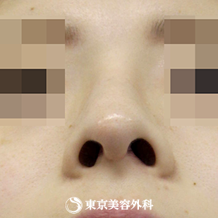 【鼻尖形成、鼻中隔延長（切開法+軟骨移植）、鼻骨骨切り、鷲鼻削り（ハンプ削り）｜si3785】の症例写真 after【8枚目】