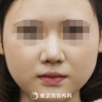 鼻尖形成、隆鼻術（プロテーゼ）｜si4833】団子鼻をシュッとしたキレイな鼻にの症例
