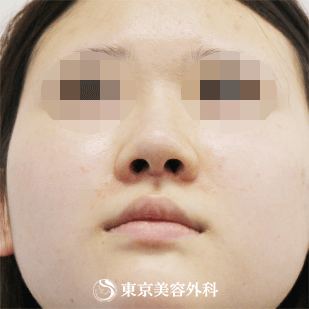 【鼻尖形成、隆鼻術（プロテーゼ）｜si4833】の症例写真 before【5枚目】